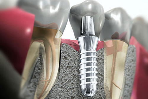 Nobel Biocare выпустила новые импланты для протезирования боковых зубов