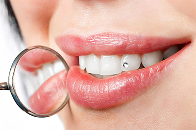 Скайсы на зубы – улыбка на миллион без вреда здоровью