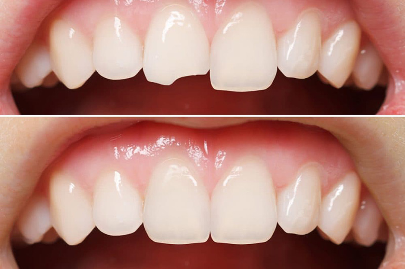 Художественная реставрация передних зубов - Семейный стоматологический центр