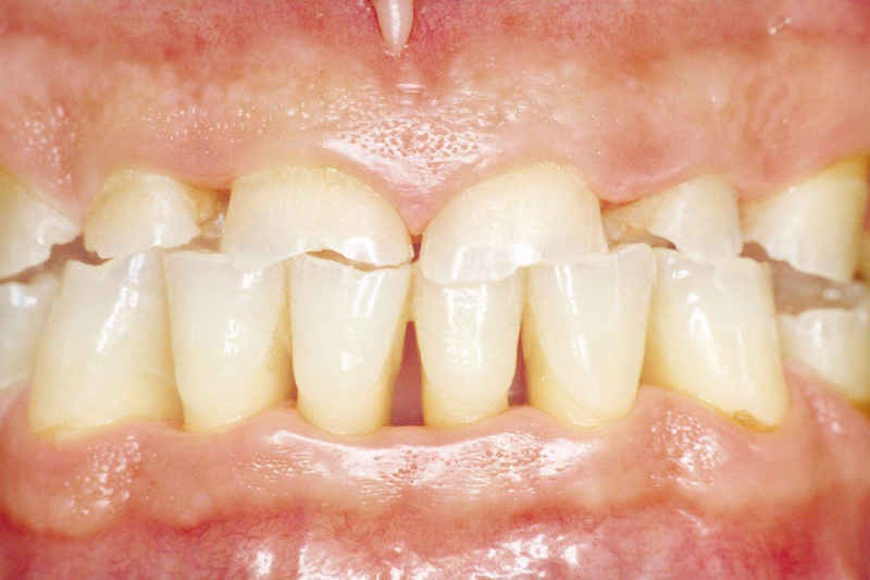 Причины патологической стираемости зубов