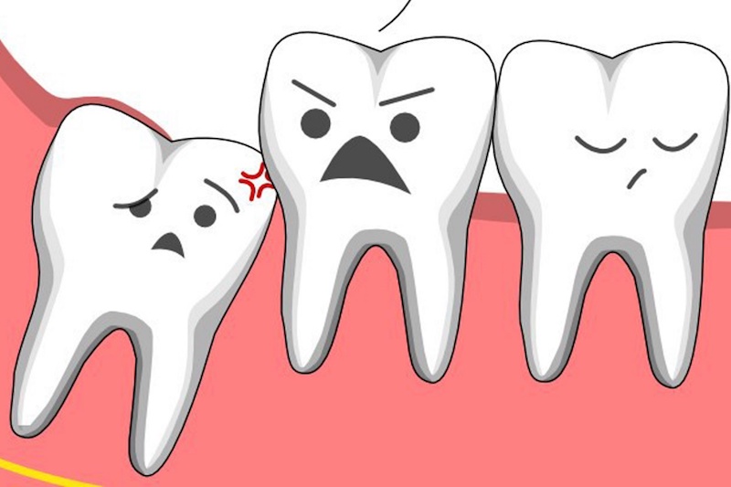 Можно ли удалять зубы мудрости при установке брекетов?