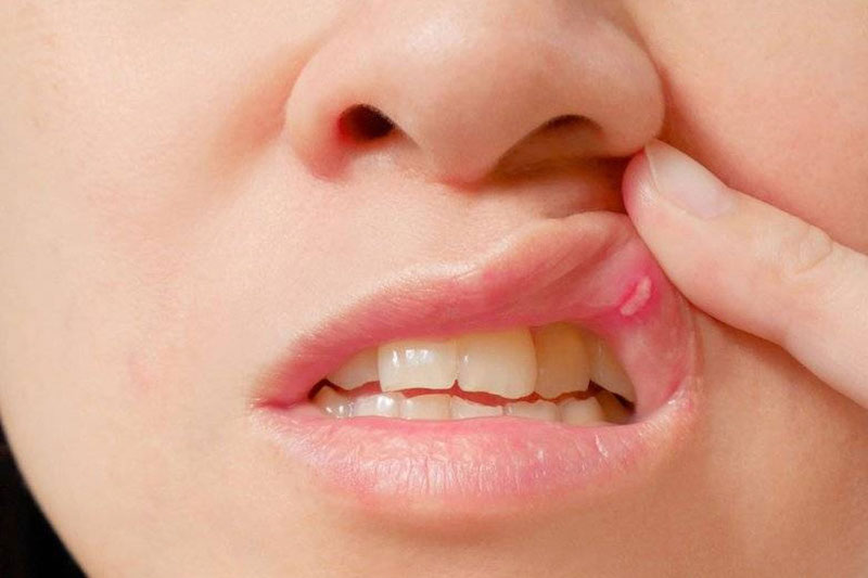Чем лечить афтозный стоматит во рту