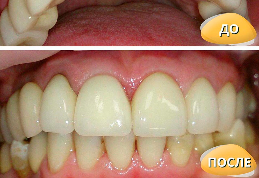 Когда один зуб меняет всё