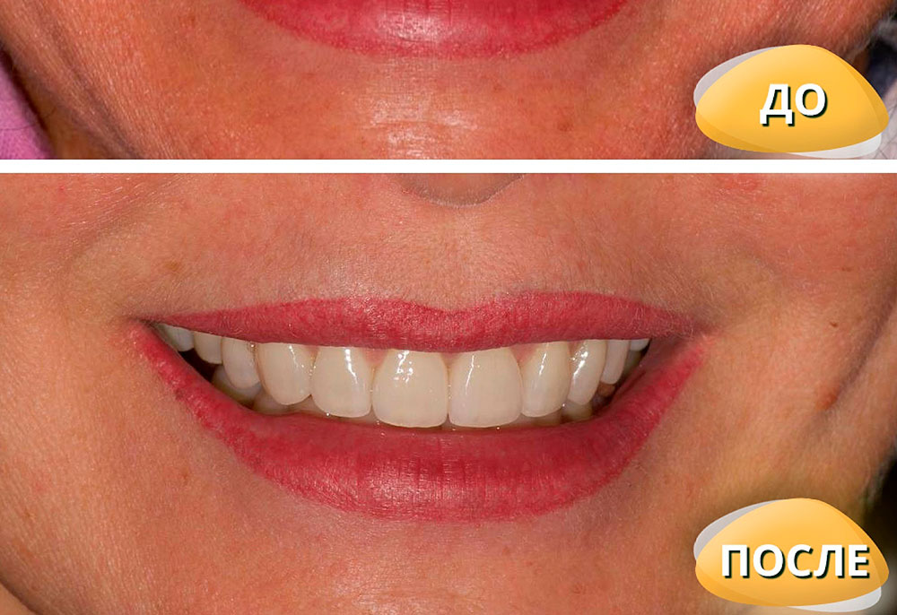 Что портит улыбку и как это исправить?