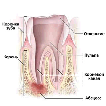 Лечение абсцесса зуба