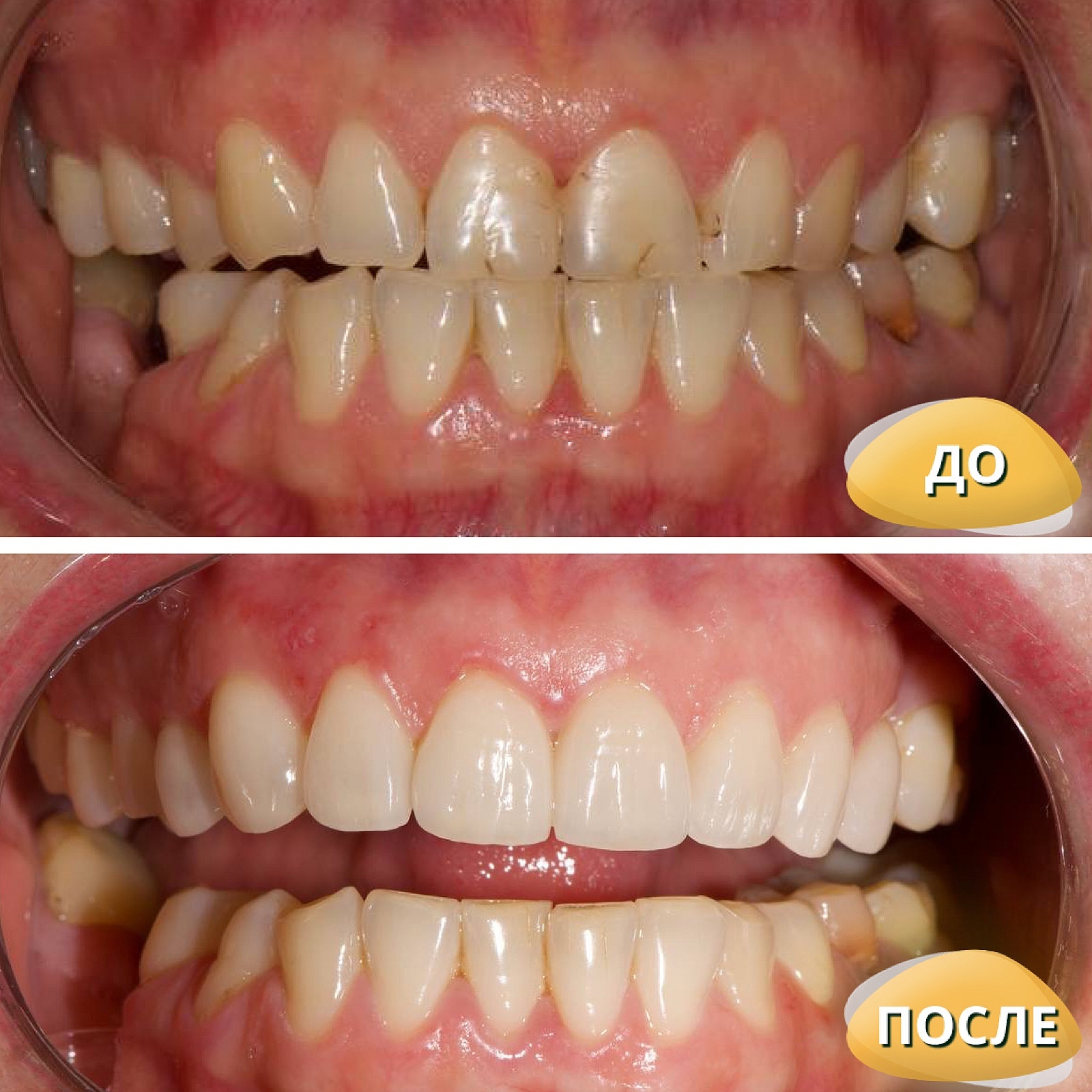 Что портит улыбку и как это исправить?